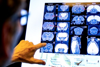 Alzheimer's research brain scans on a screen.