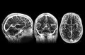 Three MRI scans of a human brain.