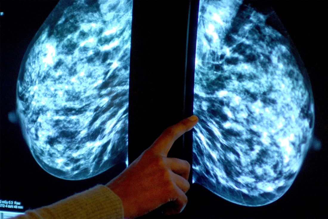 A person examines an x-ray to detect cancer in breast tissue.