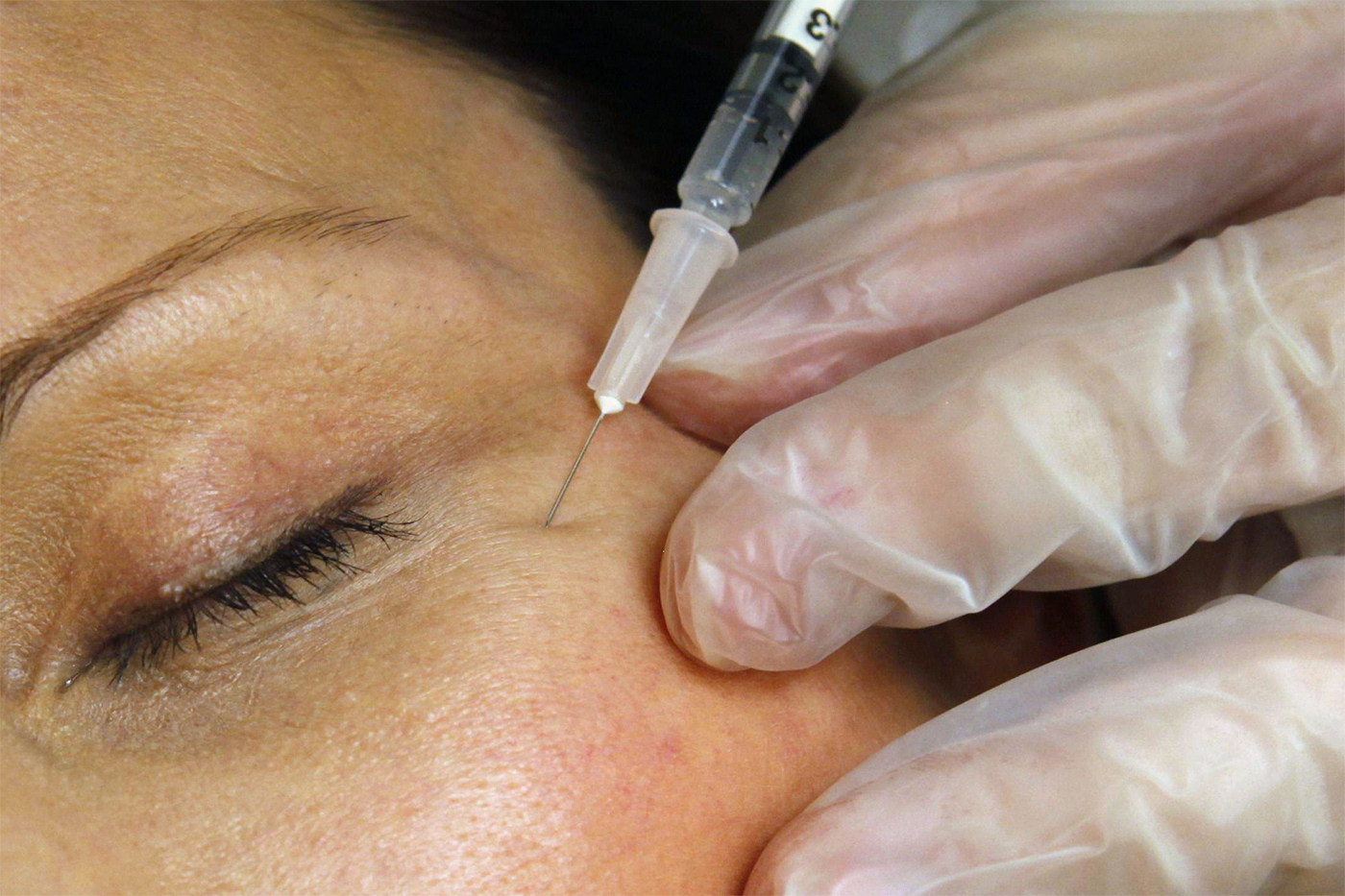 Is Botox Safe? 10 Botulism Cases Spark Safety Concerns