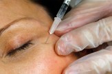 A gloved hand holding a cosmetic needle up to the skin next to a patient&#039;s eye, prepared to inject botox into their skin.
