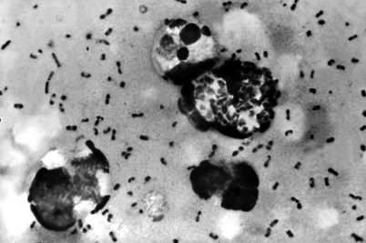 A zoomed in shot of the Pneumonic plague.