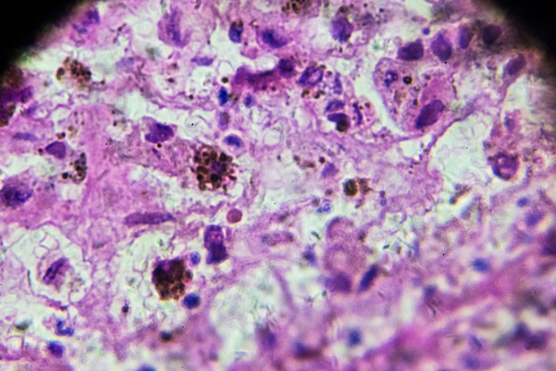 A melanoma biopsy under a microscope that looks like a purple and grey mass.