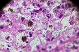 A melanoma biopsy under a microscope that looks like a purple and grey mass.
