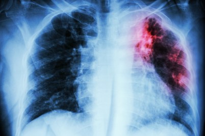 A chest x-ray showing a portion of a lung inflamed with red light.
